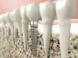 Replacing a missing tooth with a dental implant can reduce bone loss ashevill nc
