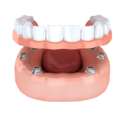 dental implant secured denture asheville nc