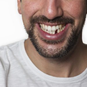 asheville nc dentist for missing teeth