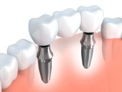 Dental implant secured bridge asheville nc