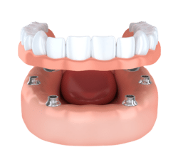 dental implant secured denture asheville nc