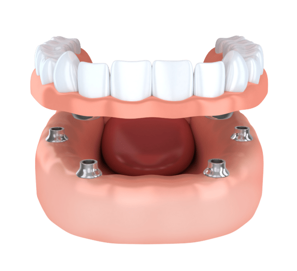 Dentures Asheville NC Partial Dentures Denture Implants
