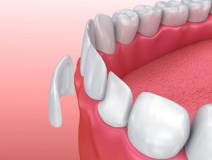 Dental Veneers Asheville NC