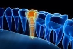 asheville, north carolina dental implants