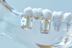 multiple dental implants in asheville, north carolina
