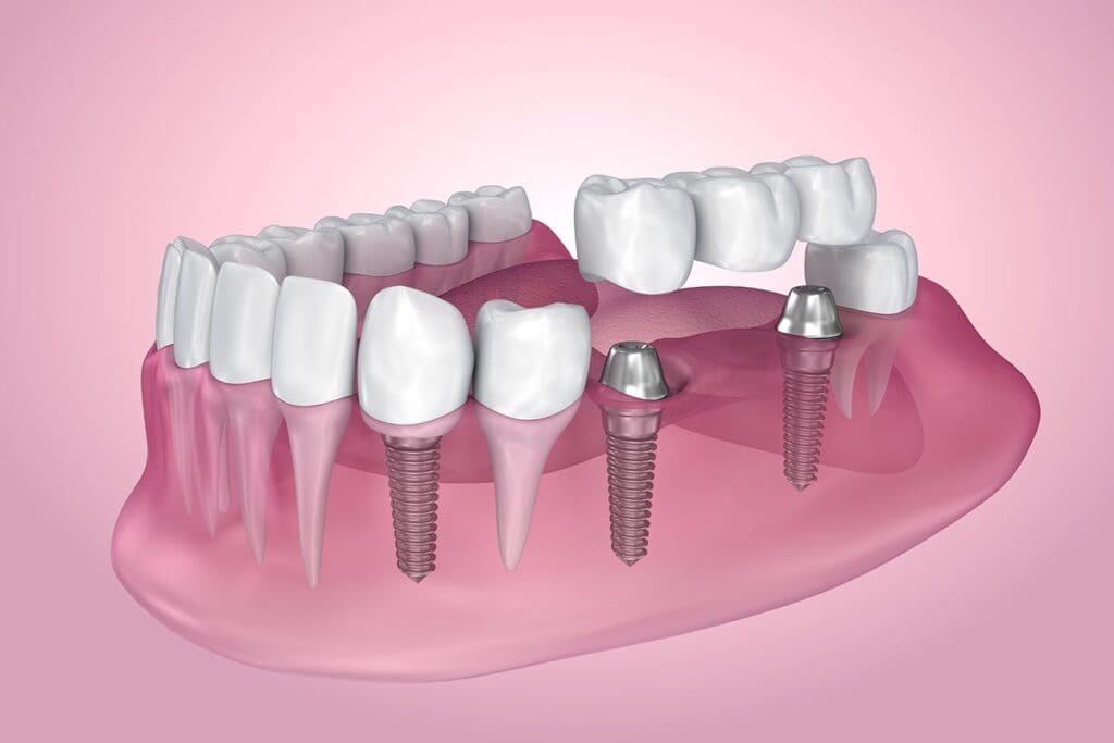 dental implant types in Asheville North Carolina
