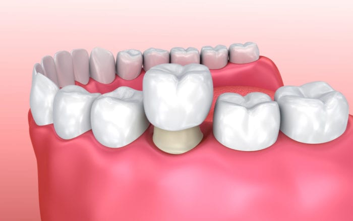 Dental Crowns in Asheville, North Carolina