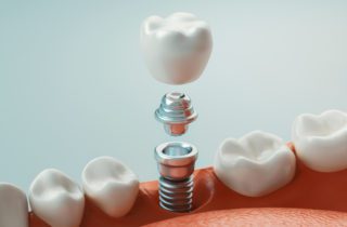 dental implants in Asheville, NC