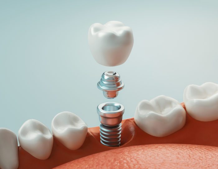 dental implants in Asheville, NC