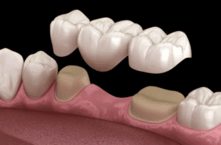 3D render of dental bridge being placed missing teeth dentist in Asheville North Carolina