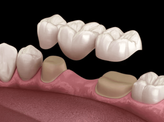 3D render of dental bridge being placed missing teeth dentist in Asheville North Carolina