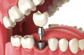Dental Implant Process