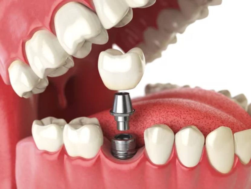 Can You Get a Temporary Tooth During the Dental Implant Process