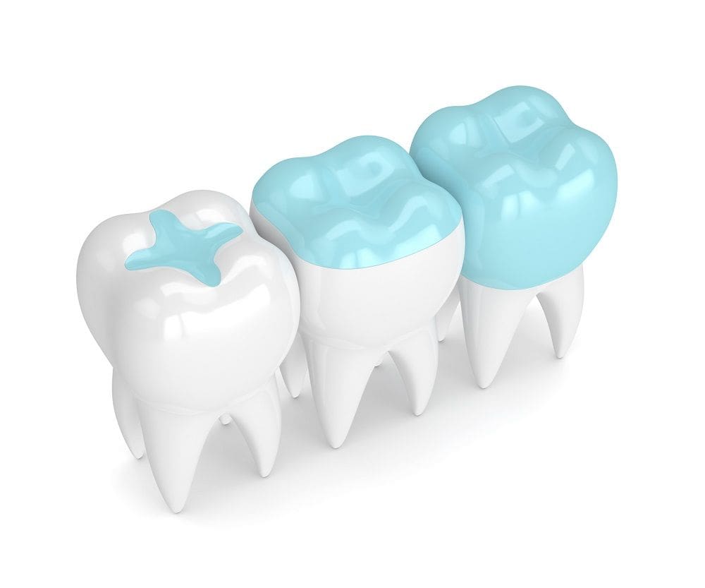 What to Know about Dental Fillings