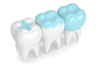 What to Know about Dental Fillings