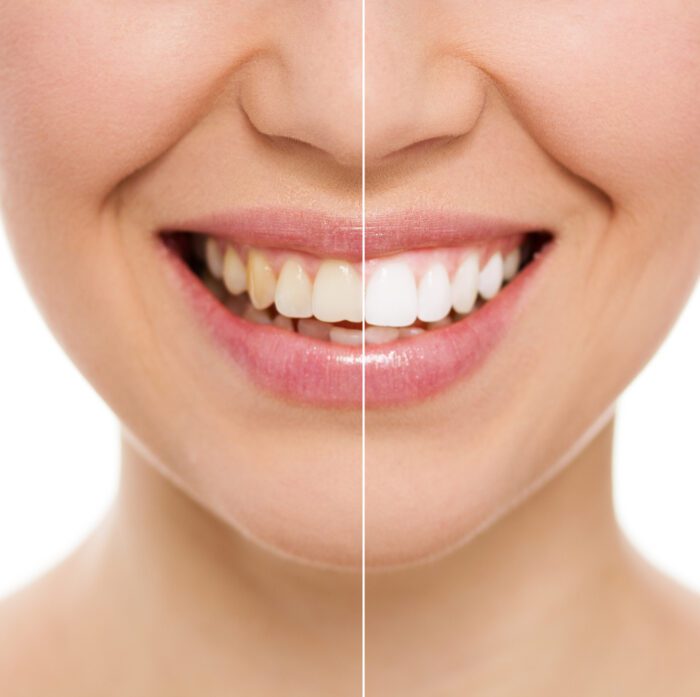 Teeth Whitening in Asheville NC