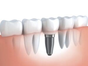 dental implants Asheville NC