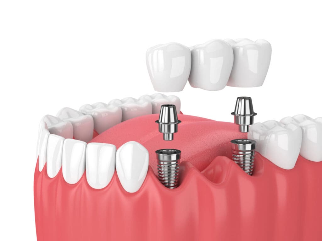 dental implant for multiple teeth asheville,nc
