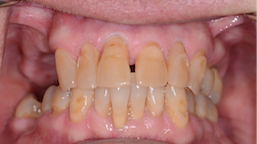 before-2-hoffert