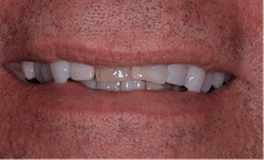 before-hoffert-3a